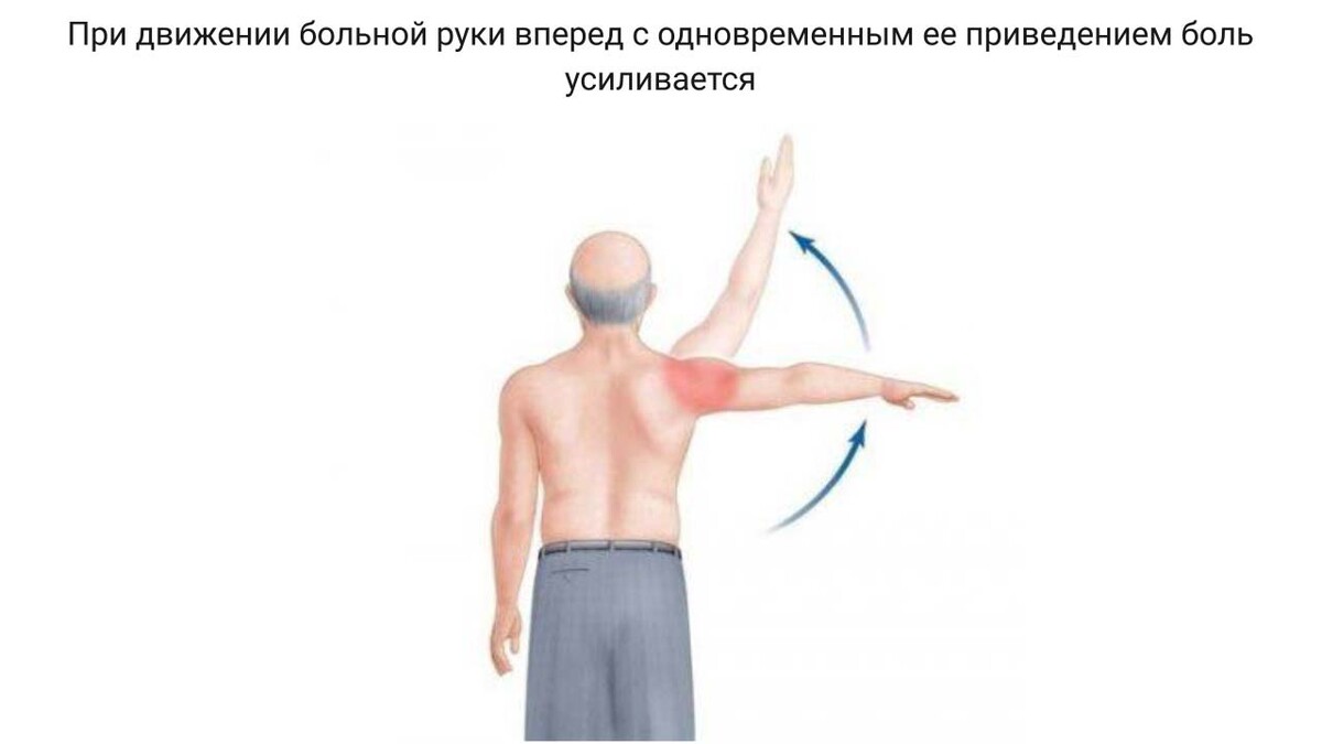 Боль при растяжение надлопаточного нерва Боль при растяжение надлопаточного нерва