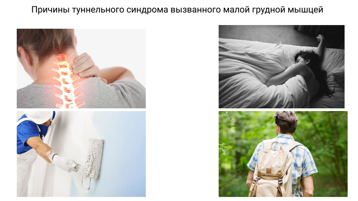 Компрессия сосудисто-нервного пучка Компрессия сосудисто-нервного пучка