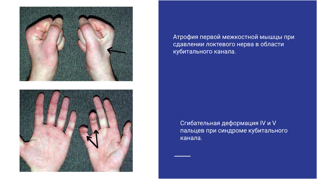 Атрофия первой межкостной мышцы и сгибательная деформация 4 и 5 пальцев Атрофия первой межкостной мышцы и сгибательная деформация 4 и 5 пальцев