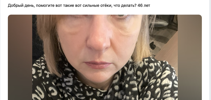 <p> <em>Как результат ваших метаний — вот такие отёки, птоз и стремительное старение лица. Коже не хватает белка, жиров, гормонов. Вы уничтожаете свою гормональную систему, зарабатывая отёки, ранний климакс и депрессию. А жир — на месте. </em></p>
<p> <em>Как результат ваших метаний — вот такие отёки, птоз и стремительное старение лица. Коже не хватает белка, жиров, гормонов. Вы уничтожаете свою гормональную систему, зарабатывая отёки, ранний климакс и депрессию. А жир — на месте. </em></p>