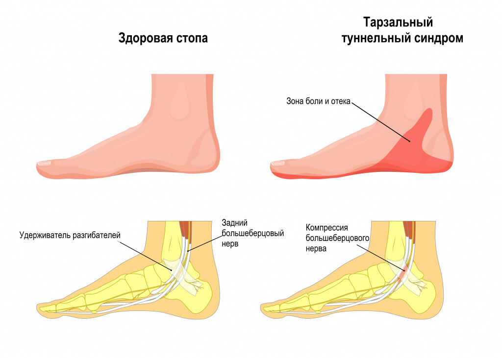 Тарзальный туннельный синдром Тарзальный туннельный синдром