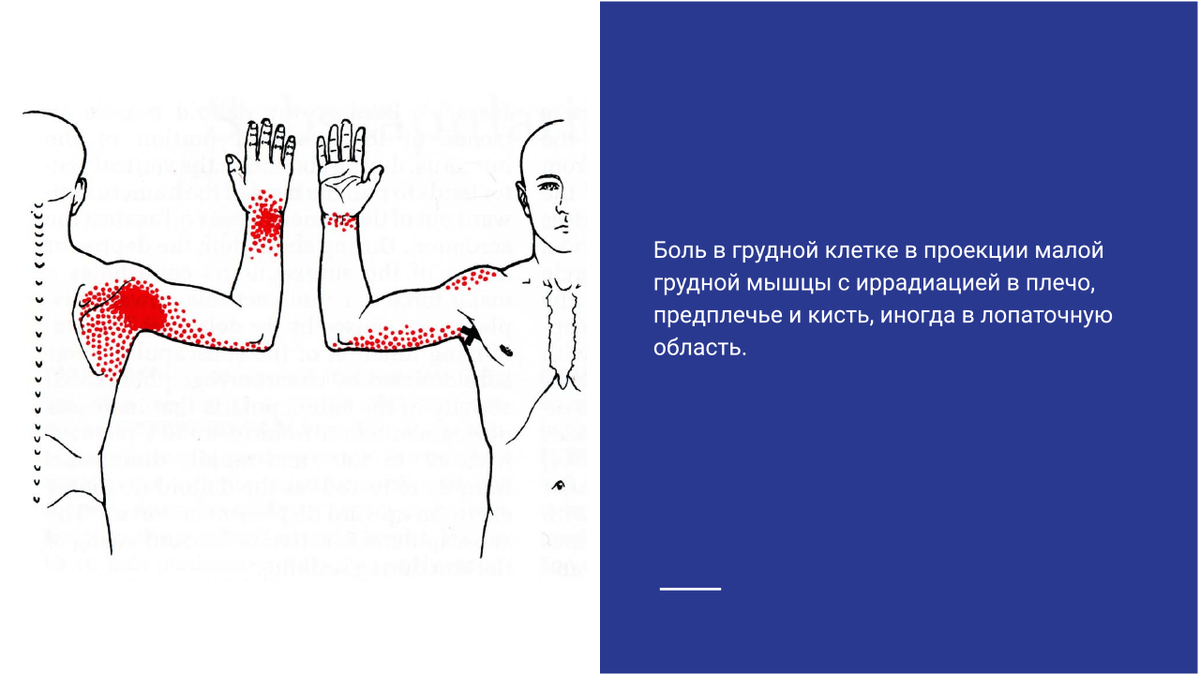 Клиническая картина туннельного синдрома, малой грудной мышцы Клиническая картина туннельного синдрома, малой грудной мышцы