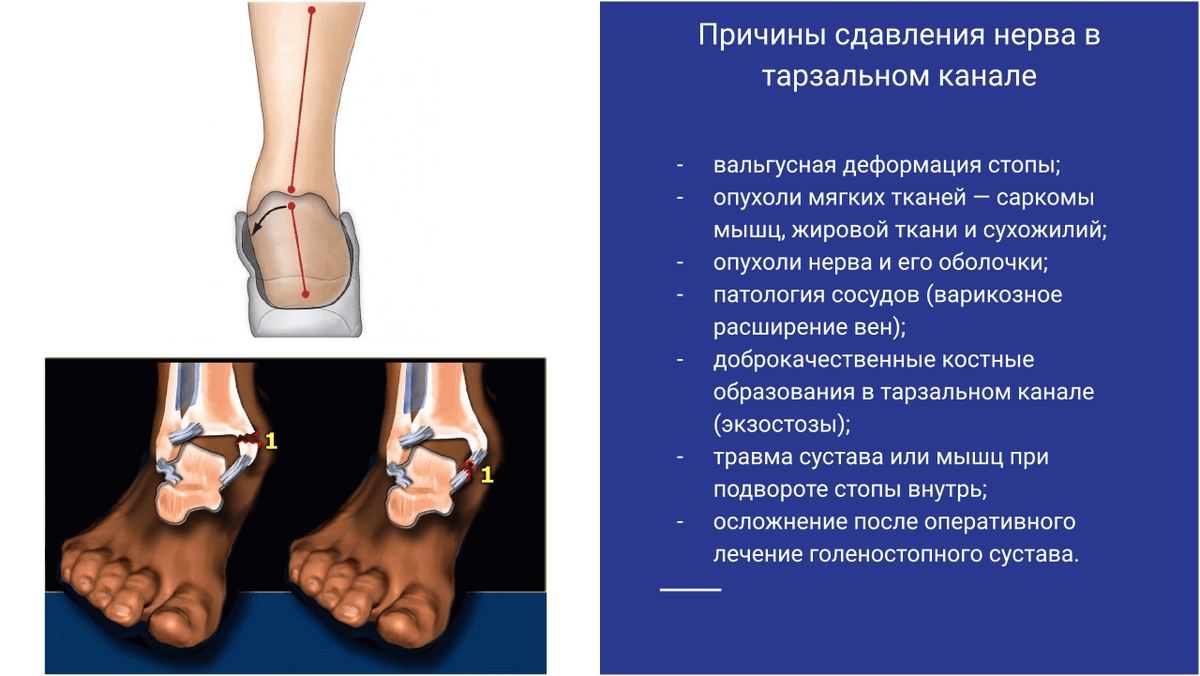 Причины сдавления нерва в тарзальном канале