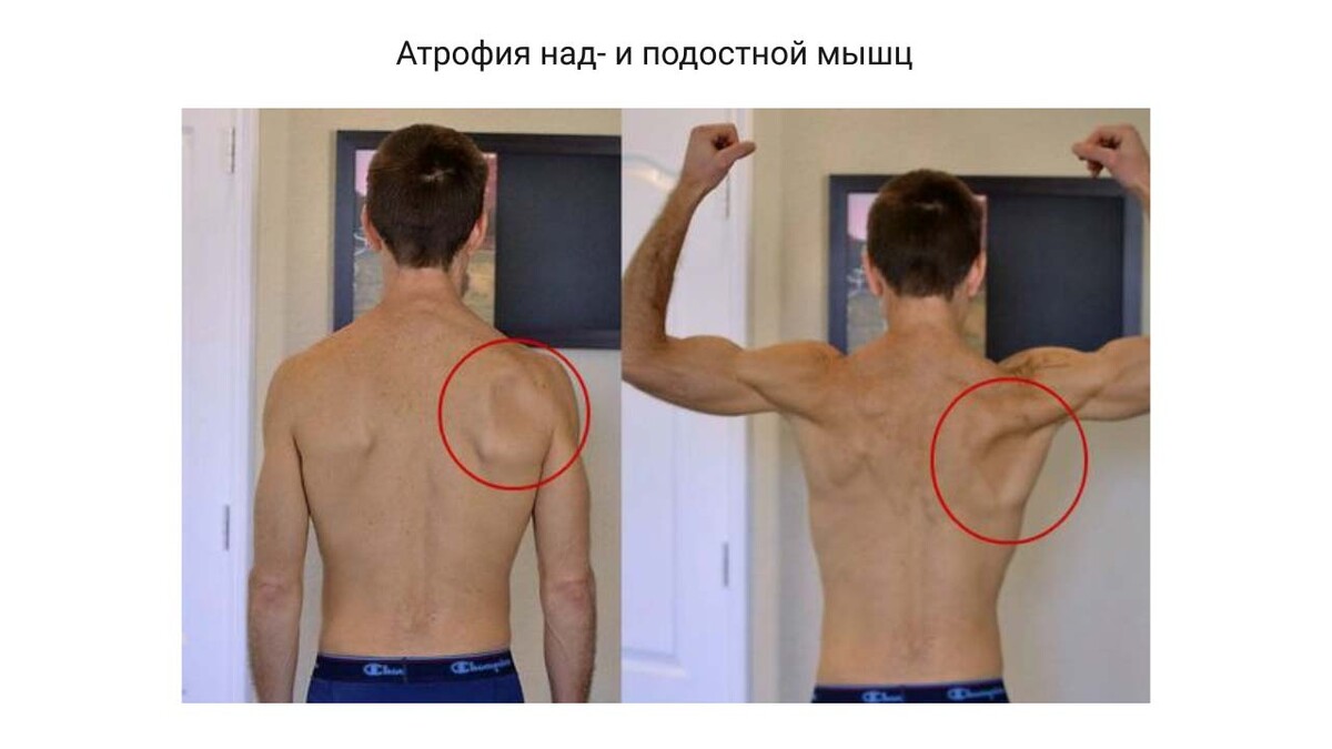 Атрофия над- и подостной мышц Атрофия над- и подостной мышц