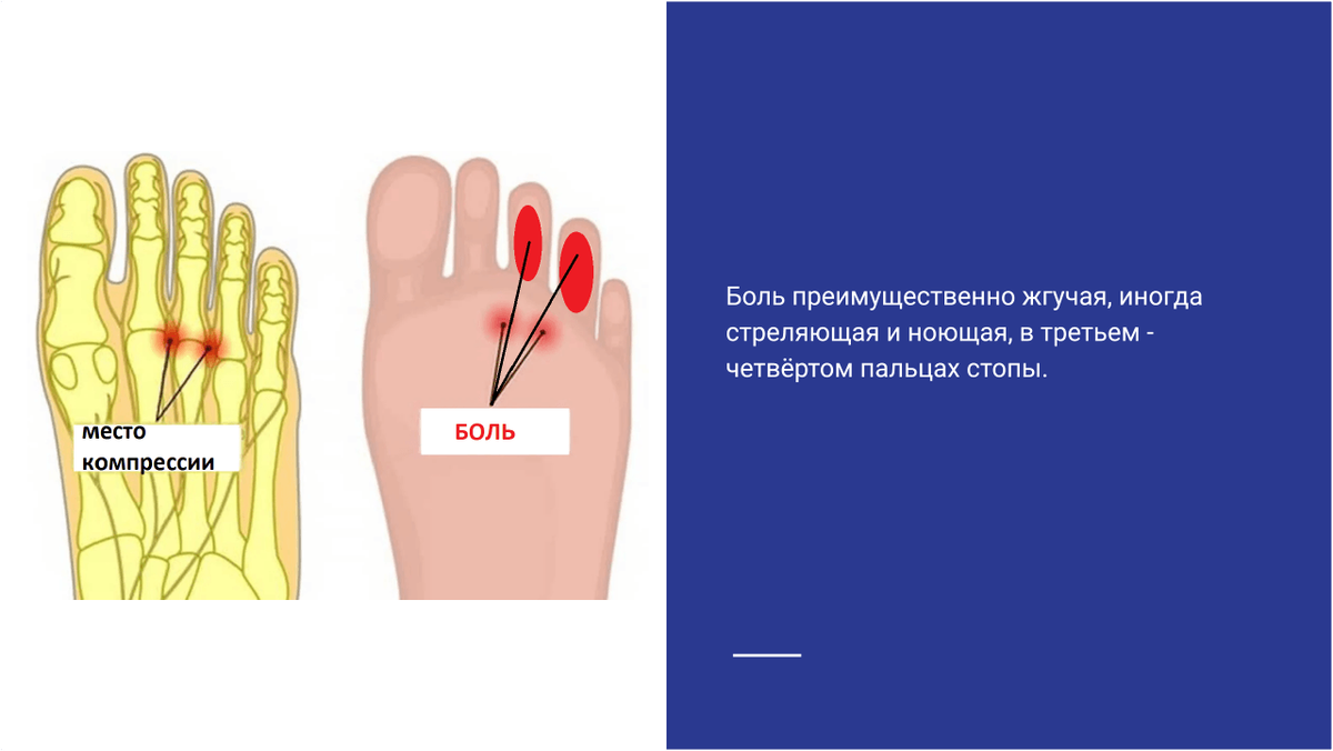 Боль при метатарзалгии Мортона. Боль при метатарзалгии Мортона.