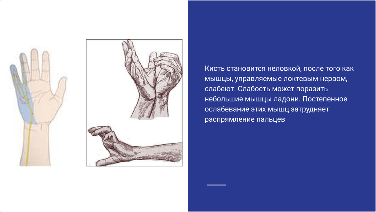 Ослабление кисти при синдроме канала Гийона Ослабление кисти при синдроме канала Гийона