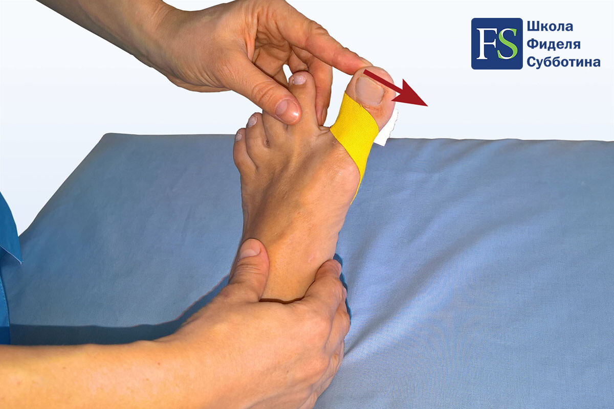 Статодинамическое тейпирование стопы при Халюс Вальгус (Hallux Valgus) - 3 Статодинамическое тейпирование стопы при Халюс Вальгус (Hallux Valgus) - 3