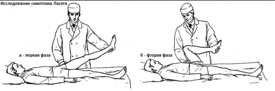Симптом Ласега Симптом Ласега
