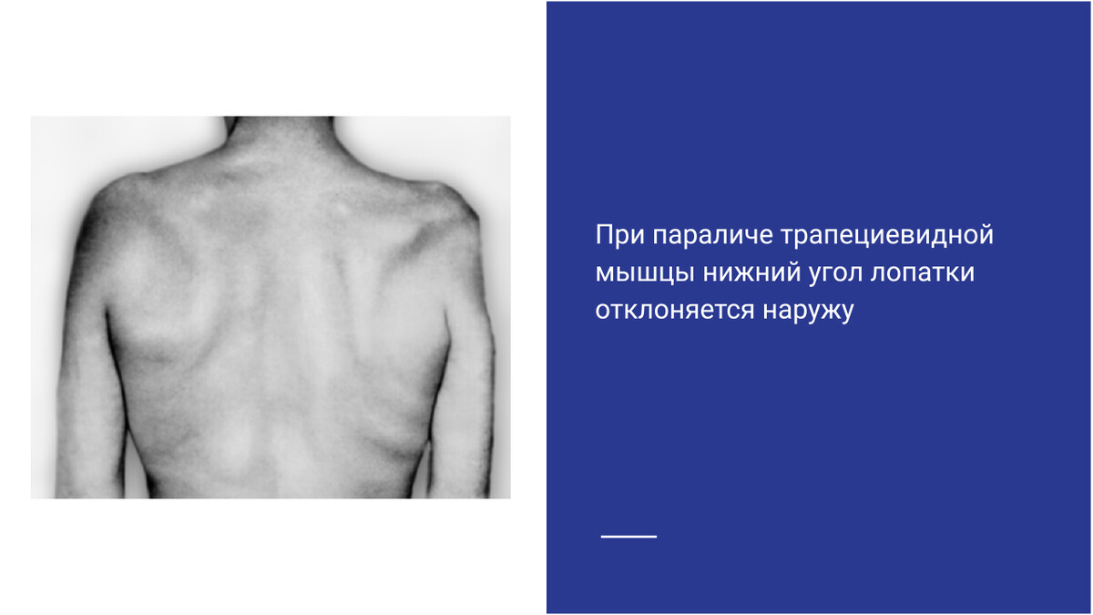 Паралич трапециевидной мышцы Паралич трапециевидной мышцы