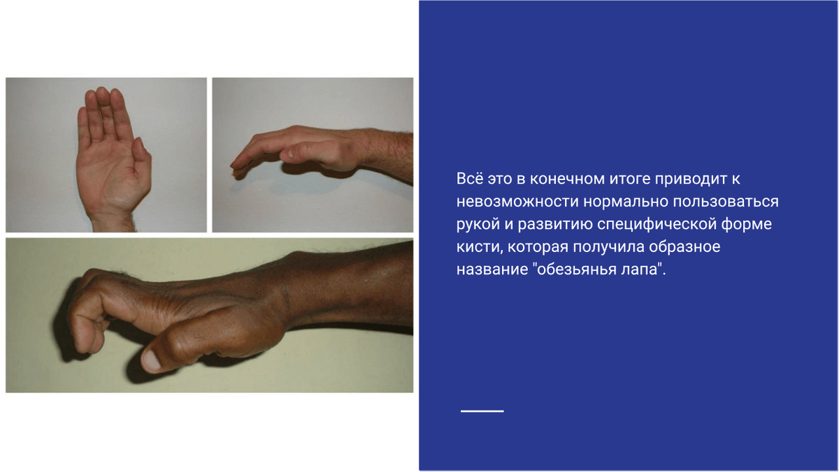 Специфическая форма кисти Специфическая форма кисти