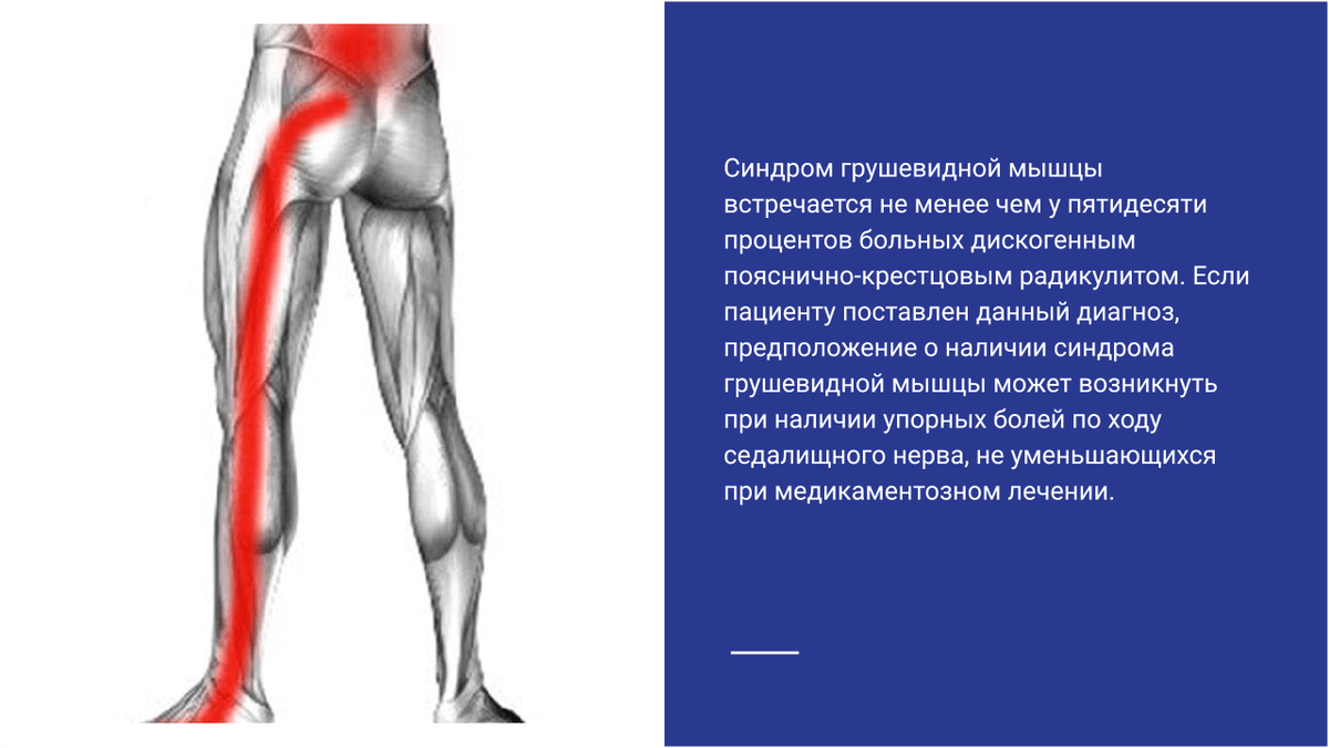 Синдром грушевидной мышцы Синдром грушевидной мышцы