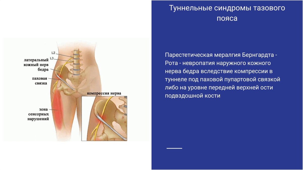 Туннельные синдромы тазового пояса Туннельные синдромы тазового пояса