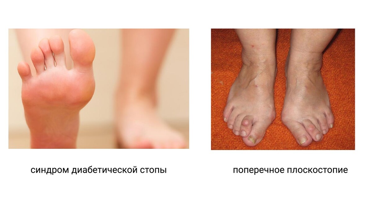 Синдром диабетической стопы, поперечное плоскостопие Синдром диабетической стопы, поперечное плоскостопие