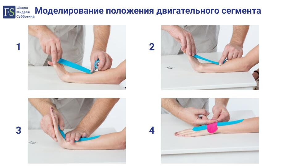 Моделирование положения двигательного сегмента при наложении тейпа Моделирование положения двигательного сегмента при наложении тейпа