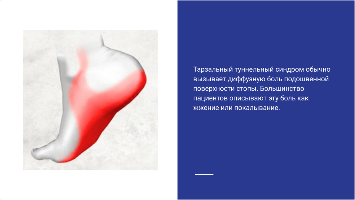 Тарзальный туннельный синдром Тарзальный туннельный синдром