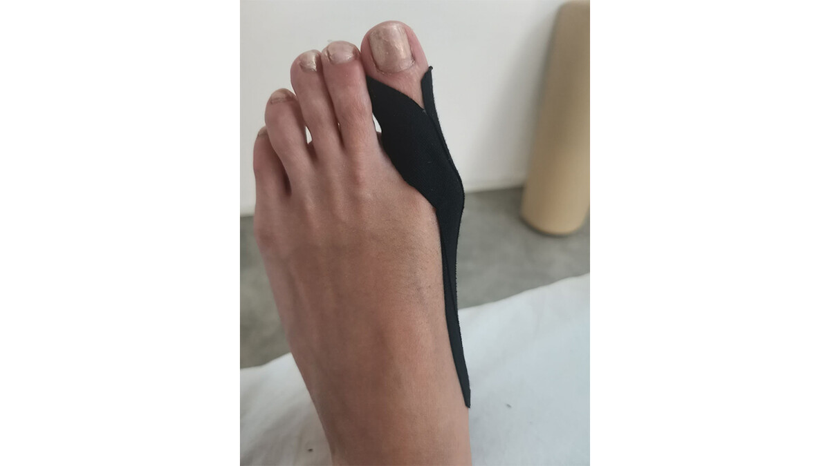 Пример аппликации при Hallyx Valgus 3 Пример аппликации при Hallyx Valgus 3