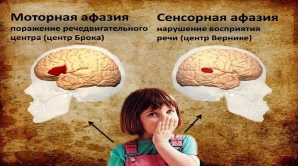 Афазия: симптомы, виды, диагностика и лечение. Блог Логопед портал