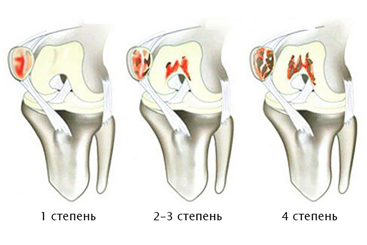 Хондромаляция суставов. Хондромаляция суставного хряща 3 степени. Хондромаляция надколенника 2-3 степени. Хондромаляция надколенника 2 степени. Хондромаляция коленного сустава 3 стадия.