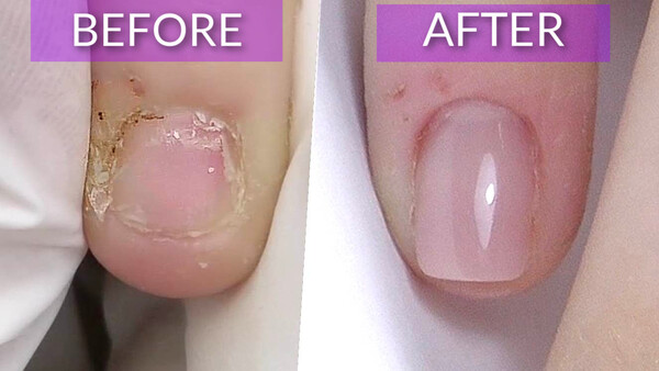 Short Bitten Nails Transformation to SQUARE shape. Blog records Short Bitten Nails Transformation to SQUARE shape. Blog records