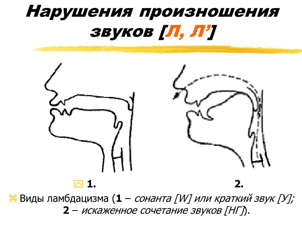 Схема взаимосвязи звуков при ринолалии