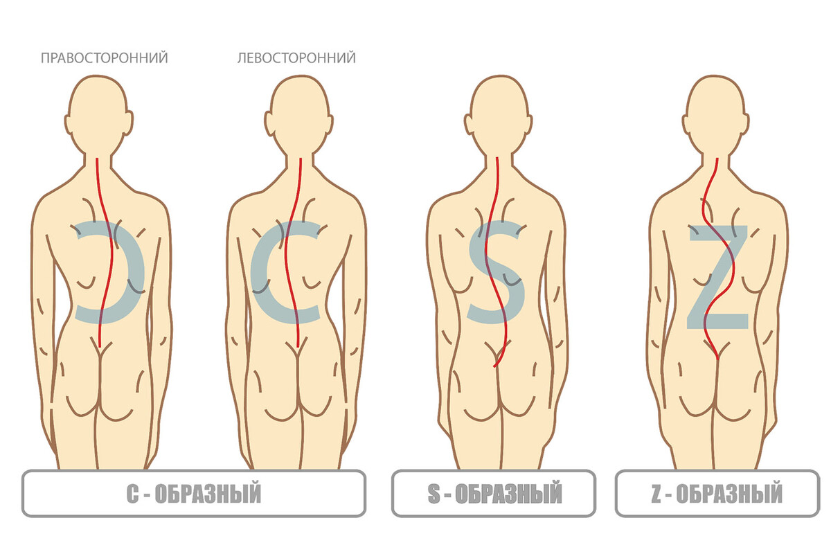Форма искривления позвоночника