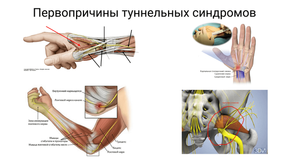 Туннельный синдром нерва