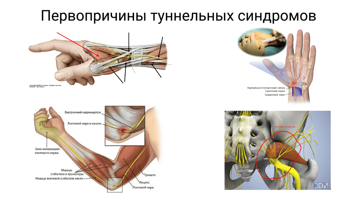 Нерв туннельный синдром