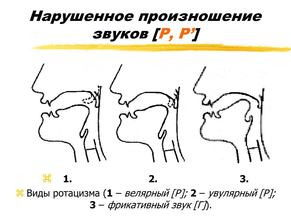 Нарушение артикуляционных схем отдельных звуков является первичным дефектом при