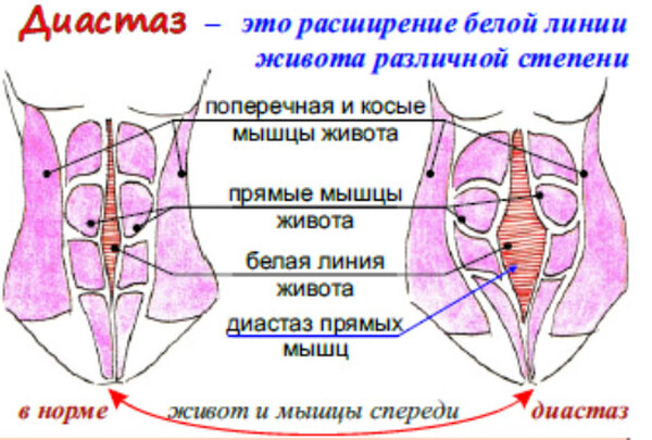 Диастаз после родов