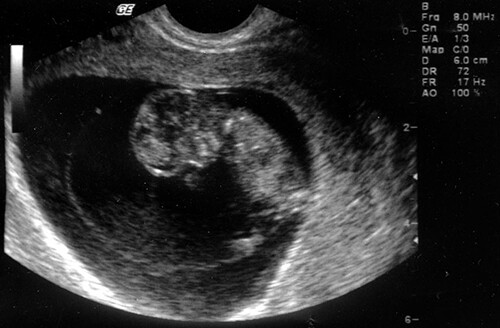 10 Недель Беременности Фото Узи Ребенка