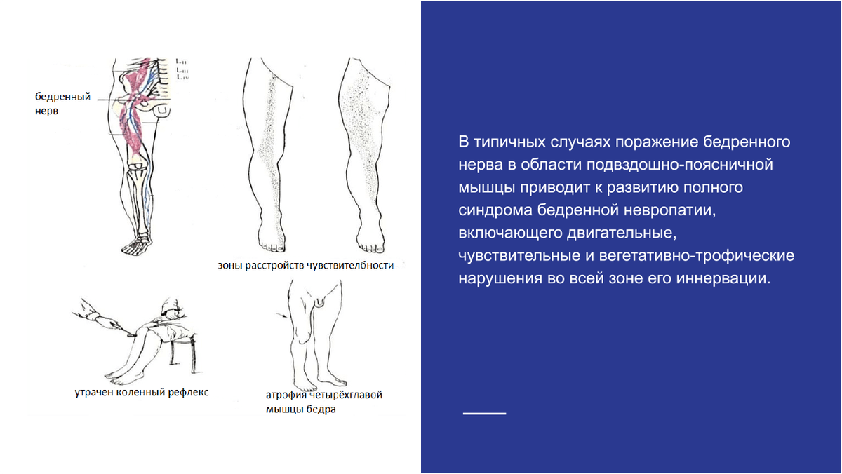 Поражение бедренного нерва