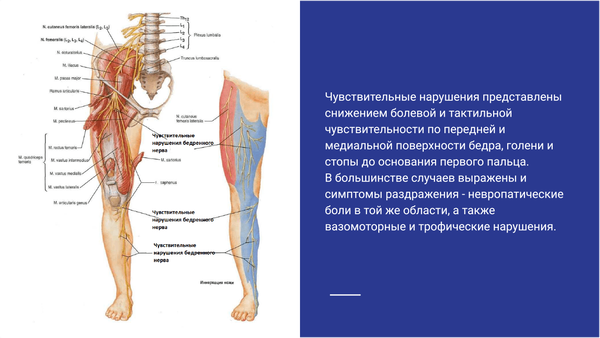 Нейропатия бедренного нерва