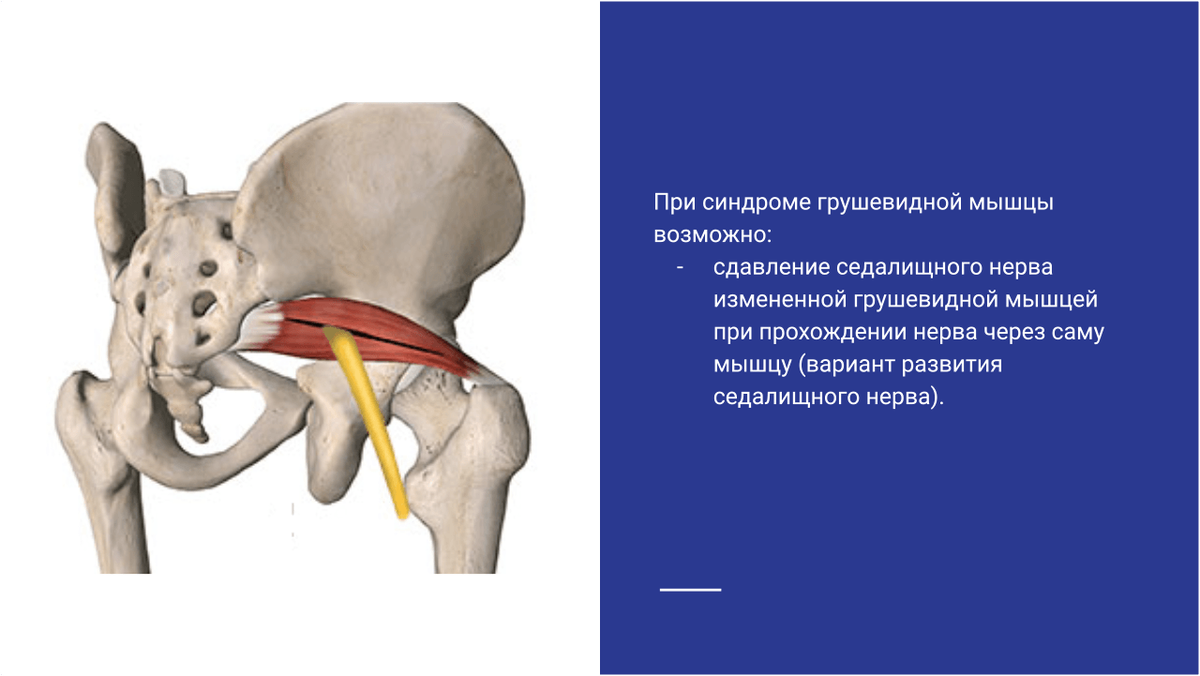 Сдавление седалищного нерва измененной грушевидной мышцей при прохождении нерва через саму мышцу