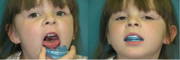 Инфантильное глотание. Блог Лого-Эксперт