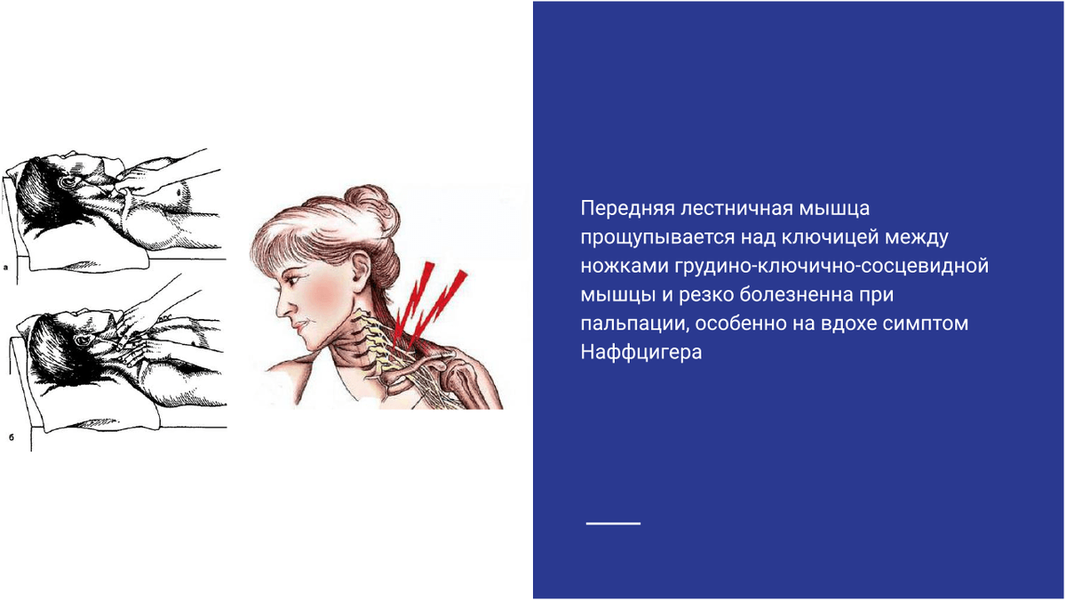 Синдром лестничной мышцы Синдром лестничной мышцы