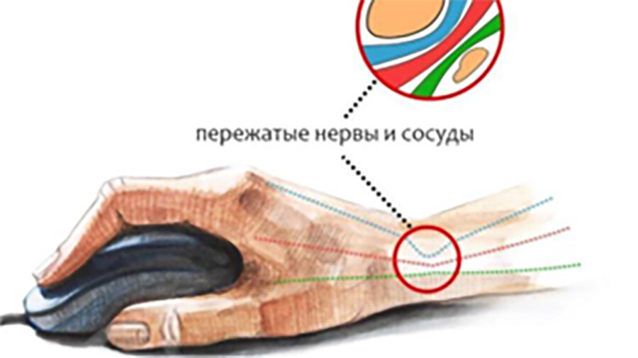 Синдром карпального канала