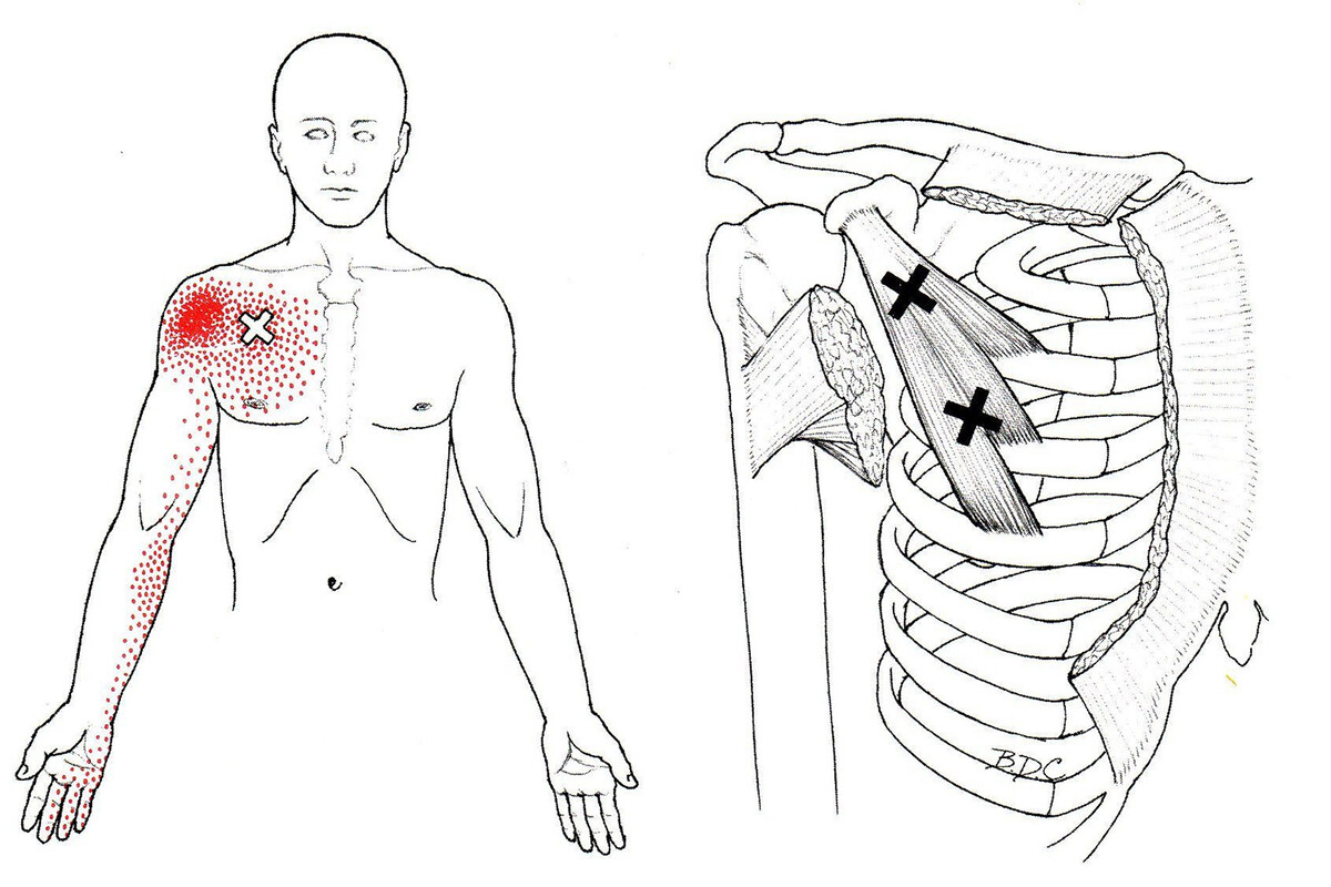Паттерн боли при туннельном синдроме вызванным малой грудной мышцей