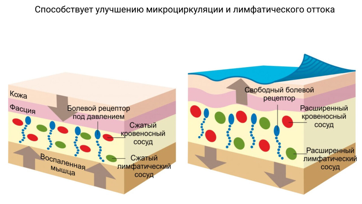 Улучшение микроциркуляции и лимфатического оттока с помощью тейпа