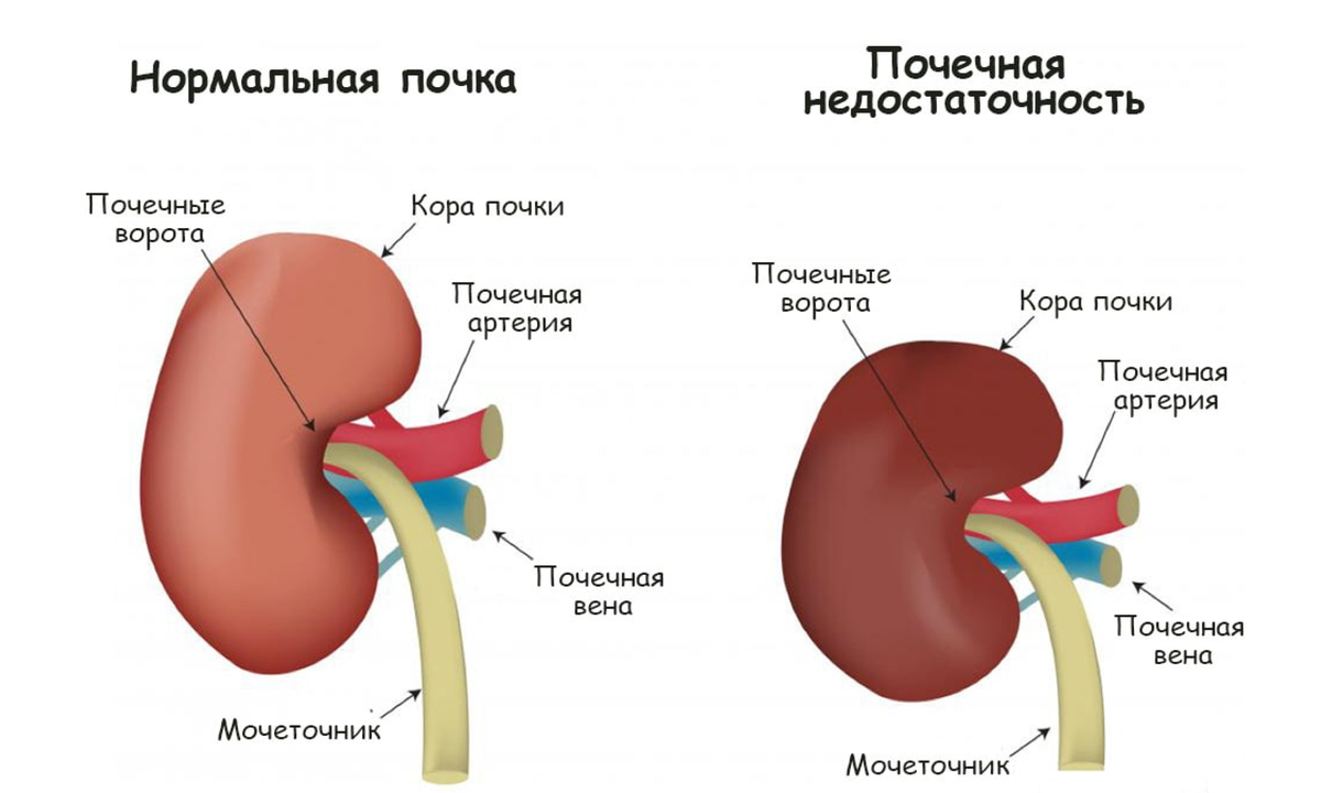 Острая почечная недостаточность картинки