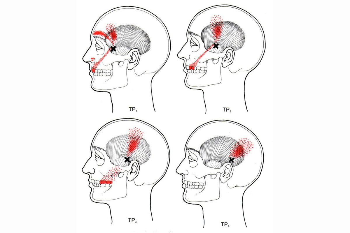 Отраженные боли вызываемые височной мышцей