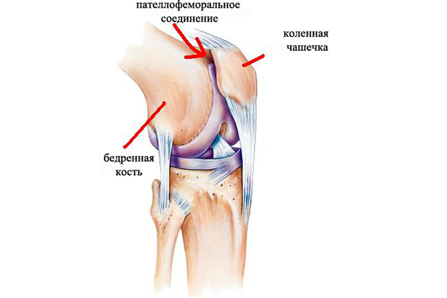Пателлофеморальный артроз коленного сустава 1 степени