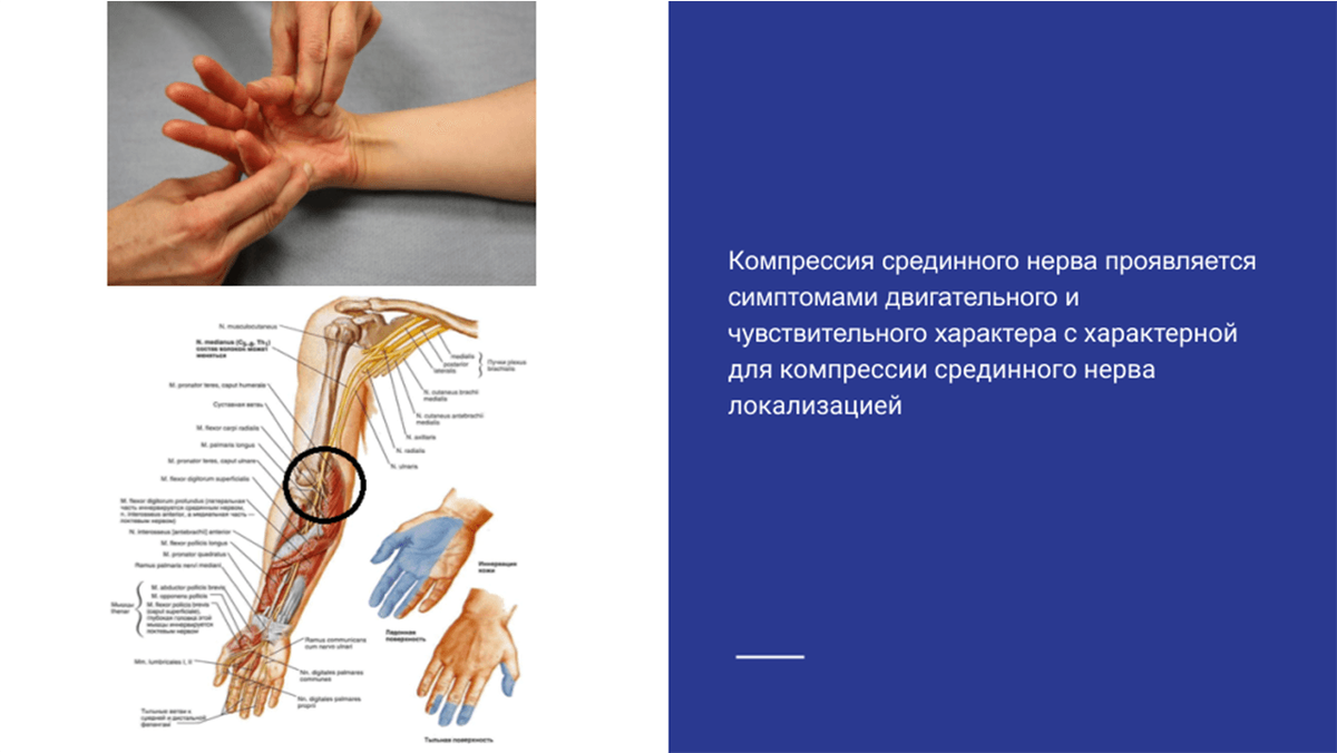 Срединный нерв на кисти картинки